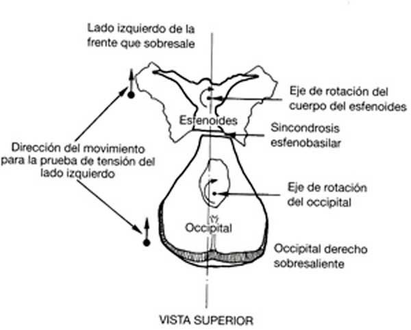 20-Tension lateral esfenobasilar